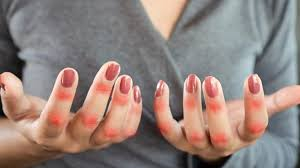 Hastalığınıza 'Kelebek' konabilir