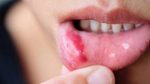 Ağzınızda bu yaralar oluyorsa tehlike altındasınız! 