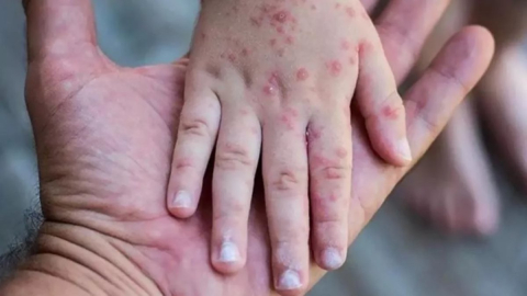 Maymun çiçeği vakaları 24 bini geçti