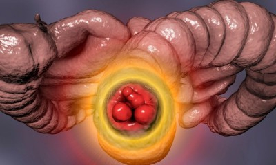 Hemoroid (Basur) Nedir? 