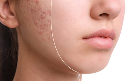 1 haftada sivilce izlerinden kurtulmak mümkün