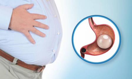 Mide balonu ile ilgili merak edilen 5 soru