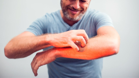 Uyuz aldı başını gidiyor!