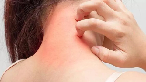 Uyuz tedavisinde sirke kullanımı nasıl olur? Evde uyuz nasıl geçer?