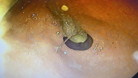 Hapşırınca  iğne yuttu!