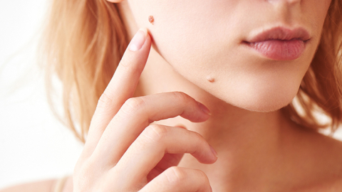 Leke ve ben oluşumlarına dikkat