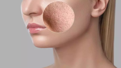 Gözenekler nasıl küçülür?