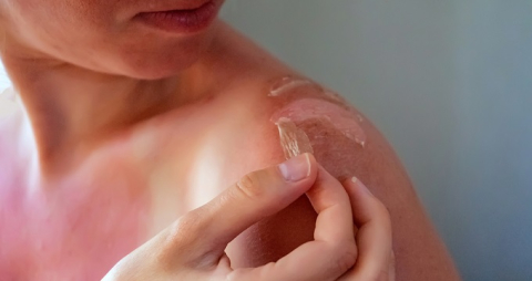 Yaz aylarında güneş yanıklarına dikkat!