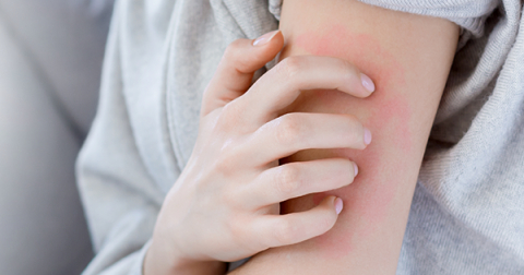 Uyuz hastalığından kurtulmak mümkün